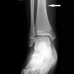 Fig. 1 Radiograph of the right lower extremity obtained at an outside facility at the time of the soccer injury (3 months prior to the initial visit at our clinic). A nondisplaced distal tibial diaphyseal fracture is evident (arrow).
