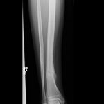 Fig. 2 Radiograph of the right lower extremity obtained 3 months after the soccer injury. Interval callus formation and slight varus deformity are present at the fracture site.
