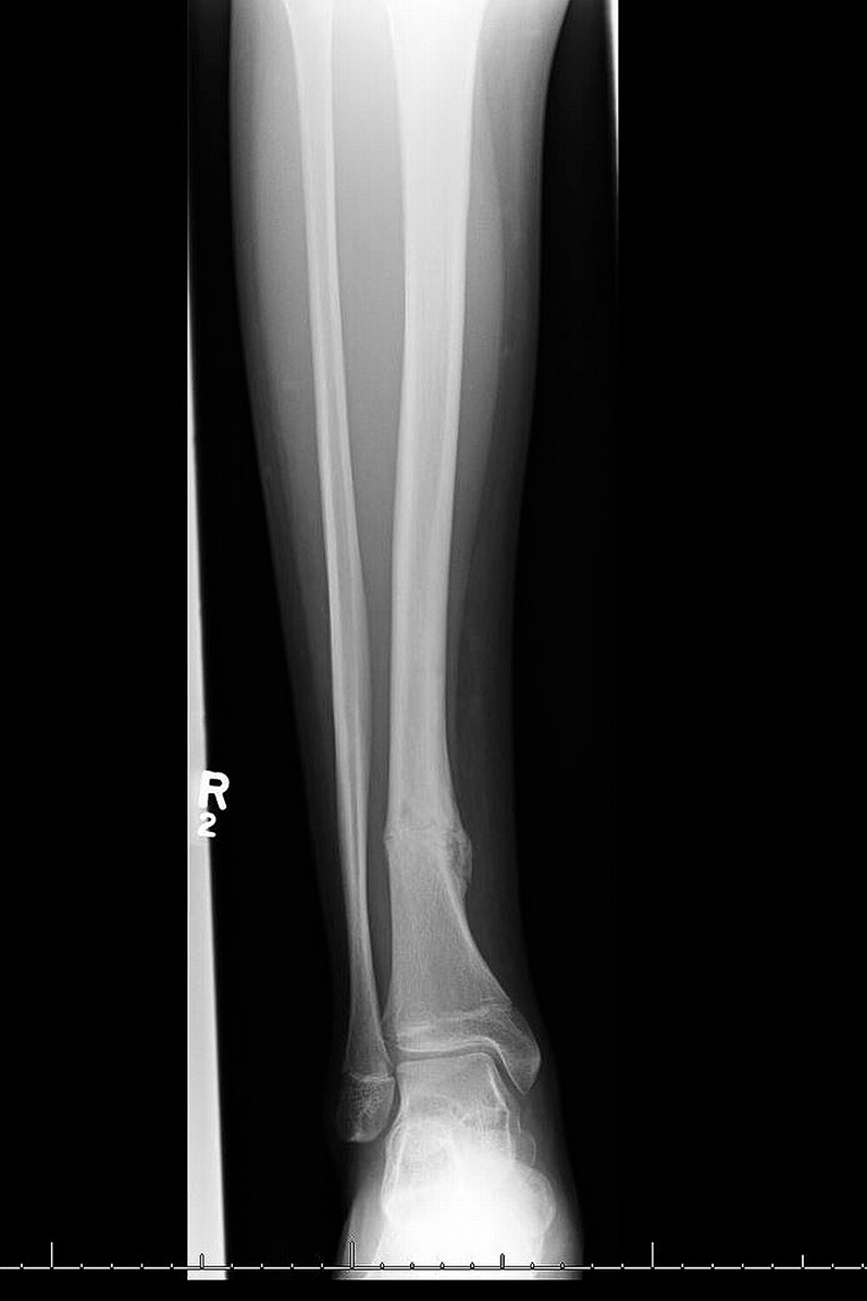 A 14 Year Old Boy With Leg Pain Following Fracture Healing JBJS Image 