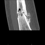 Fig. 3-B Coronal CT image of the right lower extremity obtained 4 months after the soccer injury. The image demonstrates persistent nonunion and cystic spaces with extension into the soft tissue.
