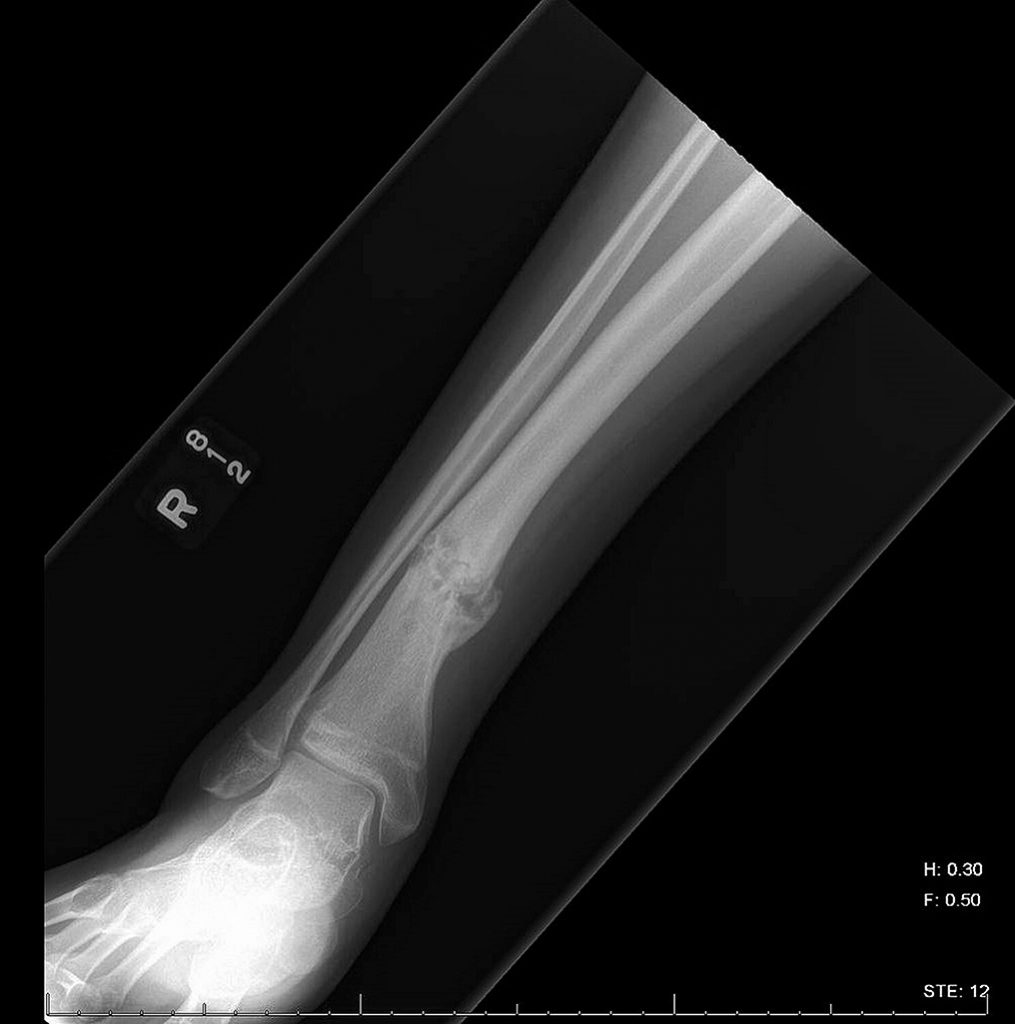 a-14-year-old-boy-with-leg-pain-following-fracture-healing-jbjs-image