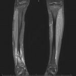 Fig. 4-B Coronal T2-weighted MRI of both lower extremities obtained during inpatient admission to the emergency department 8 months after the soccer injury.
