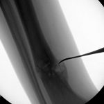 Fig. 4-C Intraoperative fluoroscopy during the open bone biopsy; imaging obtained during inpatient admission to the emergency department 8 months after the soccer injury.
