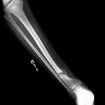Fig. 5-A Preoperative radiograph of the right lower extremity demonstrating the distal tibial-fibular osteotomy, stabilization of the proximal and distal aspects of the tibiofibular joint, and placement of the external fixator.
