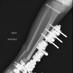 Fig. 5-B Intraoperative radiograph of the right lower extremity demonstrating the distal tibial-fibular osteotomy, stabilization of the proximal and distal aspects of the tibiofibular joint, and placement of the external fixator.
