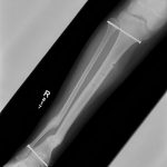Fig. 6 Anteroposterior radiograph showing the interval removal of the external fixator. There were healing fractures involving the distal diaphyses of the right tibia and fibula, with stable alignment.
