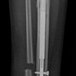 Fig. 7 Anteroposterior radiograph following the tibial-fibular osteotomy and intramedullary nailing to address the leg-length discrepancy.
