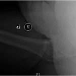 Fig. 1-B Cross-table lateral radiograph revealing diffuse enthesopathy as well as a vertically oriented displaced fracture of the femoral neck.
