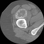 Fig. 2-A Noncontrast CT. Axial CT scan shows a peripheral pattern of mineralization of the mass anterior to the proximal aspect of the femur. There is a dense, almost corticated, external margin, some finer central mineralization, and reactive mineralization at the anterior cortex of the femur.
