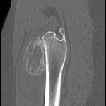 Fig. 2-B Noncontrast CT. Sagittal CT scan shows a peripheral pattern of mineralization of the mass anterior to the proximal aspect of the femur. There is a dense, almost corticated, external margin, some finer central mineralization, and reactive mineralization at the anterior cortex of the femur.
