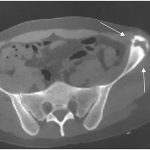 Fig. 1 Figs. 1-A, 1-B, and 1-C: Imaging. Fig. 1-A Anteroposterior pelvic radiograph (outlet view) showing the anterolateral aspect of the left ASIS with bone rarefaction (arrows). Figs. 1-B and 1-C Axial (Fig. 1-B) and coronal (Fig. 1-C) CT views of the pelvis and thigh showing the osteolytic lesion in the left ASIS (arrows).
