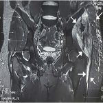 Fig. 4 Coronal T1-weighted MRI with intravenous contrast, showing contrast-enhanced fluid collection (arrows) extending from the left ASIS to the left tensor fasciae latae (E) and the vastus lateralis muscle (F). A = right iliac bone, B = gluteus medius, C = gluteus minimus, and D = right hip joint.
