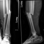Fig. 1 Anteroposterior (left) and lateral (right) radiographs of the right tibia and fibula demonstrate a comminuted, transverse, displaced fracture of the midshaft of the tibia and the fibula.
