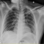 Fig. 2 Anteroposterior radiograph of the chest with diffuse interstitial opacities in the absence of pleural effusions and cardiomegaly.
