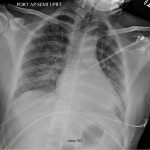 Fig. 3 Anteroposterior radiograph of the chest with worsening bilateral interstitial thickening and new hazy opacities with traces of pleural effusions.
