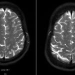 Fig. 5 MRI of the head without contrast demonstrating numerous tiny foci of acute infarction throughout the brain.
