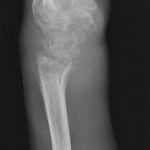 Fig. 1-B Lateral radiograph of the left wrist shows diffuse loss of joint space, osteolysis, and some cystic changes in the carpus and the radiocarpal joint.
