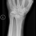 Fig. 3-A Anteroposterior radiograph of the left wrist 5 years after treatment shows evidence of the proximal row carpectomy but no progression of lysis or cystic changes.
