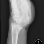 Fig. 3-B Lateral radiograph of the left wrist 5 years after treatment shows evidence of the proximal row carpectomy but no progression of lysis or cystic changes.

