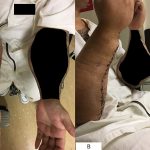 Fig. 7 Presentation at 2 weeks postoperatively. Fig. 7-A Anteroposterior photograph of both forearms for comparison, demonstrating debulking of the pseudotumor. Fig. 7-B Lateral photograph of both forearms for comparison.
