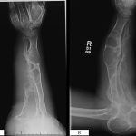 Fig. 8 One-year postoperative radiographs of the right forearm. Fig. 8-A Anteroposterior radiograph demonstrating organizing heterotopic bone formation around the previous osseous debulking sites of the forearm. Fig. 8-B Lateral radiograph demonstrating organizing heterotopic bone formation around the previous osseous debulking sites of the forearm.
