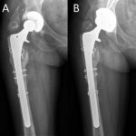 Fig. 1 Anteroposterior preoperative (Fig. 1-A) and postoperative (Fig. 1-B) radiographs demonstrating revision of the acetabular component and liner.
