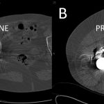 Fig. 2 Double-contrast CT arthrography was performed with iodine and air. Air-fluid levels were visible when the patient was in the supine position (Fig. 2-A) and when the patient was switched to the prone position (Fig. 2-B).
