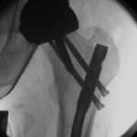 Fig. 2-A Under image intensifier guidance, the anteroposterior radiograph demonstrates hip screw placement to avoid the Birmingham prosthesis.
