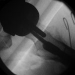 Fig. 2-B Under image intensifier guidance, the lateral radiograph demonstrates hip screw placement parallel but anterior to the stem of the Birmingham prosthesis.
