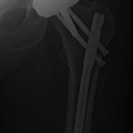 Fig. 3-A Anteroposterior radiograph demonstrating osseous union at the 6-month follow-up.
