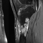 A 37-Year-Old Man with Continuing Left Knee Pain