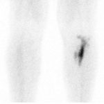 Fig. 2 December 2009: the lesion shows intense 99mTc uptake in all 3 phases of the bone scan.
