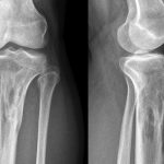 Fig. 3 January 2010: anteroposterior (left) and lateral (right) radiographs show mixed ill-defined radiolucent/radiodense abnormalities in the proximal tibial metadiaphysis as well as in the proximal fibular metaphysis.
