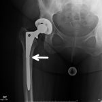 Fig. 1 Preoperative anteroposterior radiograph of the right hip demonstrating a fractured (arrow) fully porous-coated femoral component.
