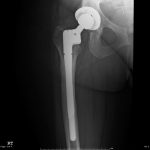 Fig. 2-A Six-week postoperative anteroposterior radiograph of the right hip demonstrating a well-positioned revision femoral component without femoral fracture.
