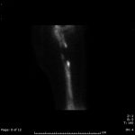 Fig. 3-B One-year postoperative lateral scintigraphic image of the right femur demonstrating a 4 to 5-cm segment of decreased isotope uptake in the middle third of the femoral diaphysis.
