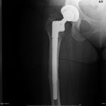 Fig. 4-A Fourteen-month postoperative anteroposterior radiograph of the right hip.
