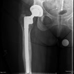 Fig. 5-A Six-year postoperative anteroposterior radiograph of the right hip.
