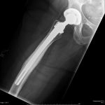 Fig. 5-B Six-year postoperative table-down lateral radiograph of the right hip.
