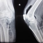 Fig. 1 Radiograph showing gas shadows in the suprapatellar pouch and in the soft tissues of the posteromedial aspect of the proximal part of the calf.
