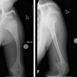 Fig. 1 Radiographs demonstrating a lesion in the proximal aspect of the humerus with a mixed osteoblastic and osteolytic appearance. The lesion arises within the metaphysis and extends into the diaphysis. Cortical erosion and a periosteal reaction also are evident.
