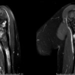 Fig. 2 Postcontrast-enhanced (gadolinium) fat-saturated T1-weighted MRI demonstrating heterogeneous enhancement within the proximal aspect of the left humerus with an associated soft-tissue mass projecting from the posterior aspect of the humerus.
