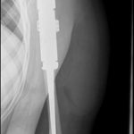 Fig. 3 Postoperative radiograph demonstrating the proximal humeral resection and the endoprosthetic reconstruction.
