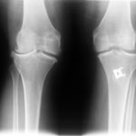 Fig. 1 Anteroposterior radiograph of both knees revealing bilateral joint space narrowing, lateral subluxation of the tibia, and a tibial tubercle staple in the left tibia (younger brother).
