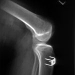 Fig. 2 Lateral radiograph of the left knee showing the tibial tubercle staple (younger brother).
