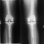 Fig. 3 Postoperative anteroposterior radiographs of both knees (younger brother).
