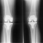 Fig. 5 Postoperative anteroposterior radiographs of both knees (older brother).
