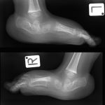 Fig. 1 Lateral radiographs when the patient was 2 years old.
