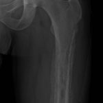 Fig. 1-A Posteroanterior radiograph of the left femur demonstrating periosteal changes and underlying osseous lucency. This radiograph shows the proximal part of the femur.
 

