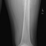 Fig. 1-B Posteroanterior radiograph of the left femur demonstrating periosteal changes and underlying osseous lucency. This radiograph shows the distal part of the femur.
